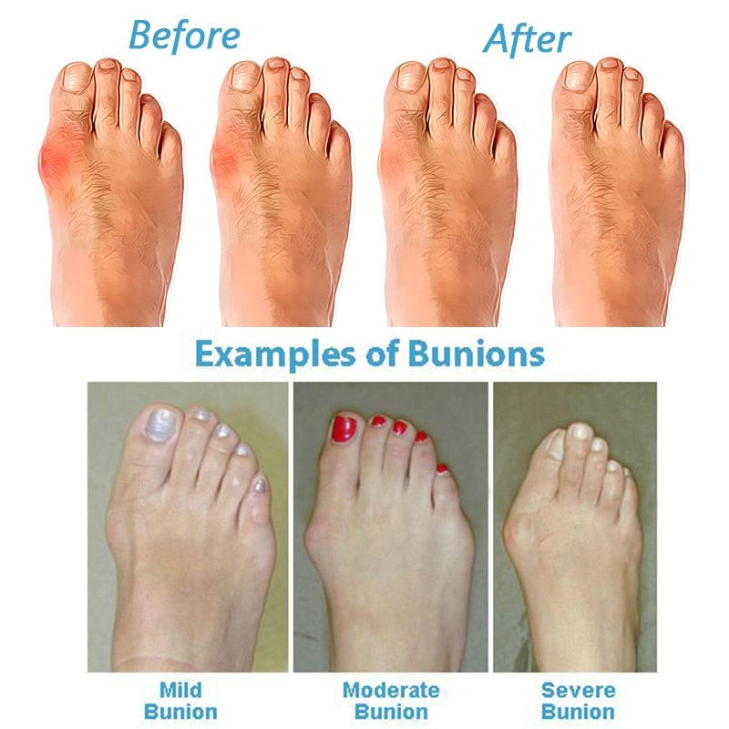 Bequeme Damen Sandalen, orthopädisch, mit verstellbaren Riemen für optimalen Halt und Komfort bei Hallux Valgus.