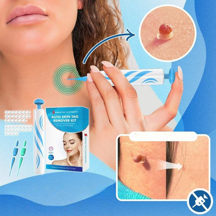 Detailansicht des Hautanhängsel Entferner Sets: Präzise Abbindeschlaufen für sichere und effektive Anwendung.