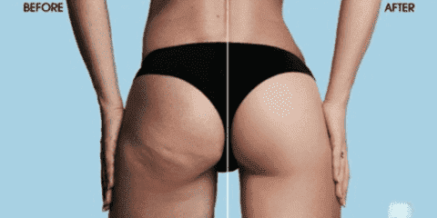 Flexibler Silikon-Schröpfbecher für Vakuummassage. Reduziert Cellulite & fördert Durchblutung der Haut.