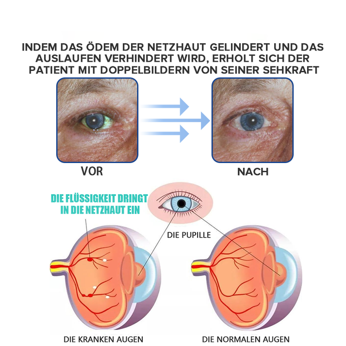 Spezielle Augentropfen fördern klare Sicht & dauerhaften Komfort, ideal bei trockenen & müden Augen.