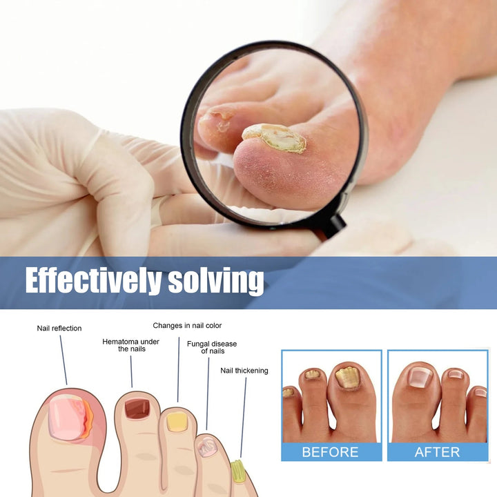 Nahaufnahme eines diskreten Nagelpflege-Pflasters, optimal für Problemzonen an Nägeln.