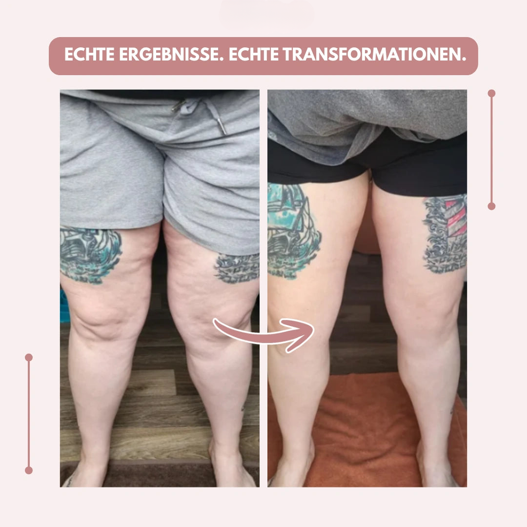 Formgebende Damen Kompressionsleggings, High Waist, lindert Schmerz bei Lipödem.