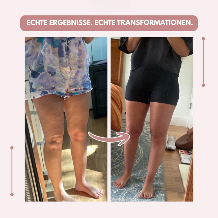Flexible Kompressionsleggings, Damen, hohe Taille, für Lipödem Schmerzlinderung.