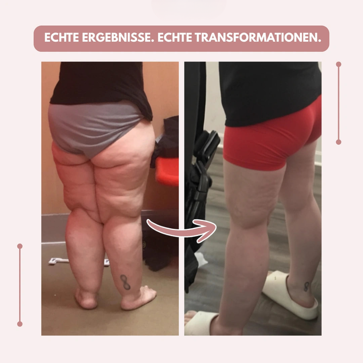 High Waist Kompressionsleggings für Frauen, ideal bei Lipödem und zur Schmerzlinderung.