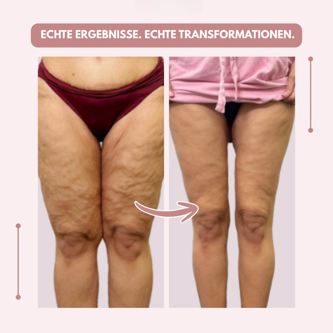 Flexible Kompressionsleggings für Lipödem, Alltag & Sport, bietet Schmerzlinderung.