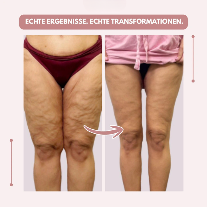 Flexible Kompressionsleggings für Lipödem, Alltag & Sport, bietet Schmerzlinderung.
