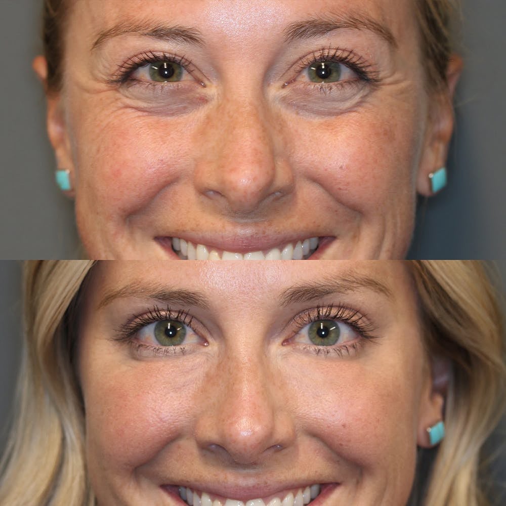 Anti-Aging Retinol Augenpflegestift für Frauen, reduziert Falten & strafft die Augenpartie. Mit Squalane.