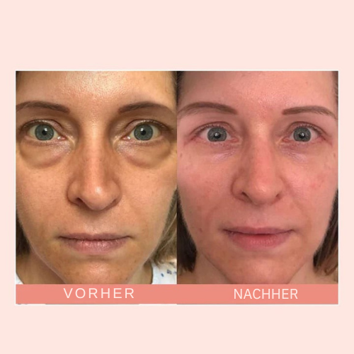 Feuchtigkeitsspendender Retinol Augencreme Stick mit Sheabutter, gegen Falten, Augenringe & trockene Augen. Skincare.
