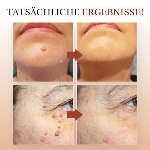 Teebaumöl-Serum für Akne und unreine Haut. Schnelleinziehendes Serum für beruhigte, klare und gepflegte Gesichtshaut.