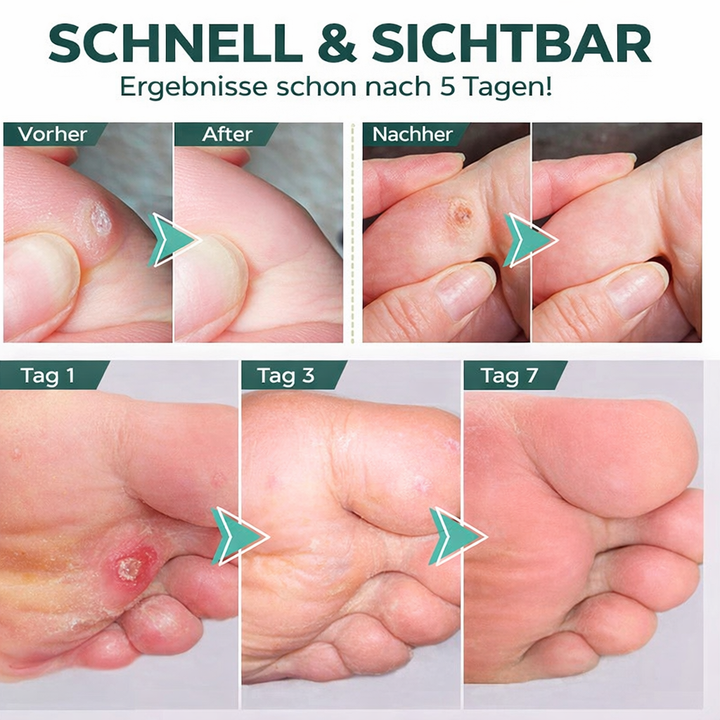 Anwendung des Hornhautentferner Gels auf Füßen für schmerzfreie Pediküre, gezielte Behandlung von Hühneraugen.