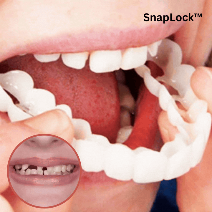 Kosmetische Snap-On Zahnprothese für ein sofortiges, schönes Lächeln. Einfach aufzusetzen und zu tragen.