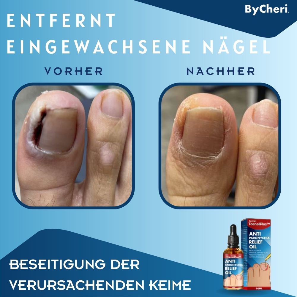 Hochwirksames Nagelöl zur Reparatur & Pflege von strapazierten Nägeln; fördert Nagelregeneration für Beauty.