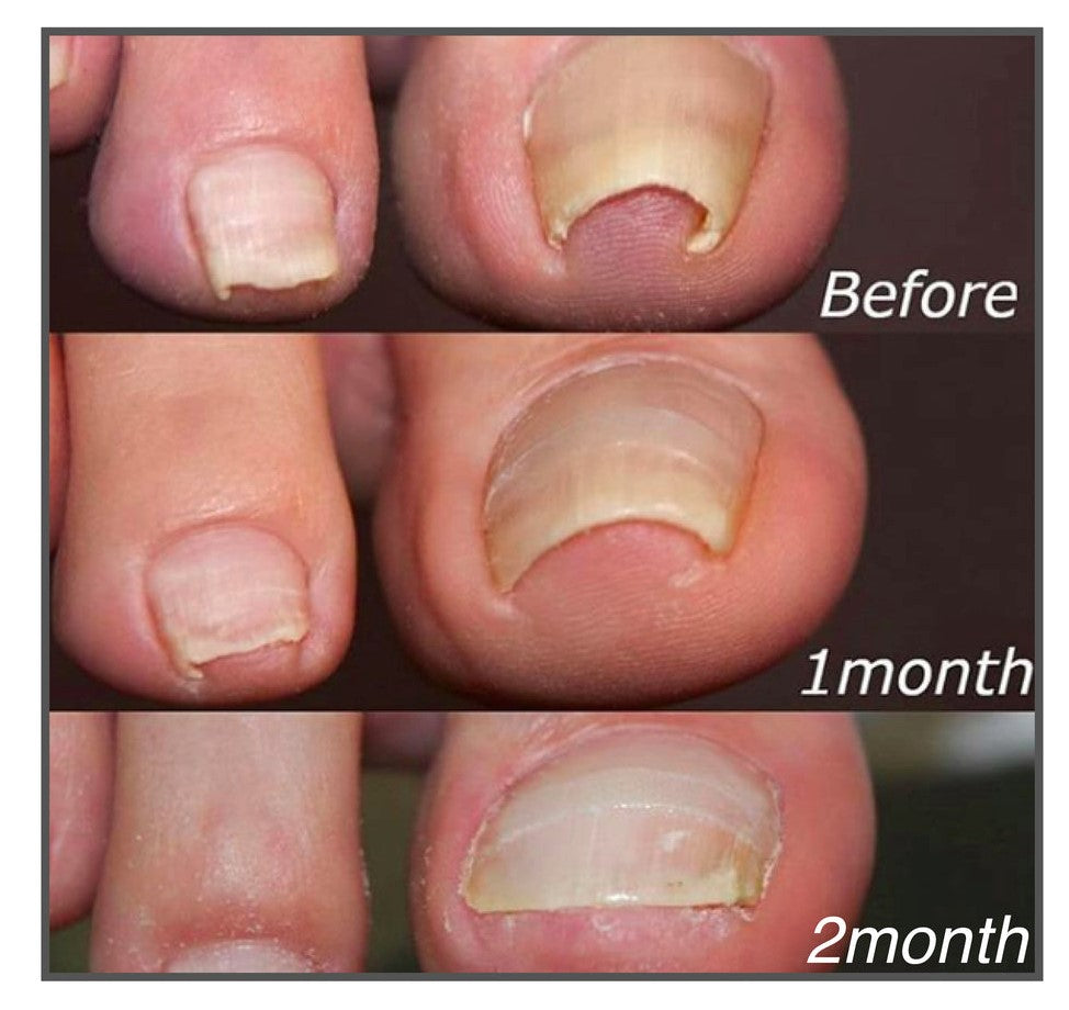 Praktische Nagelpflege-Pflaster zur optischen Korrektur von Zehennägeln. Perfekt für diskrete Pediküre zu Hause.