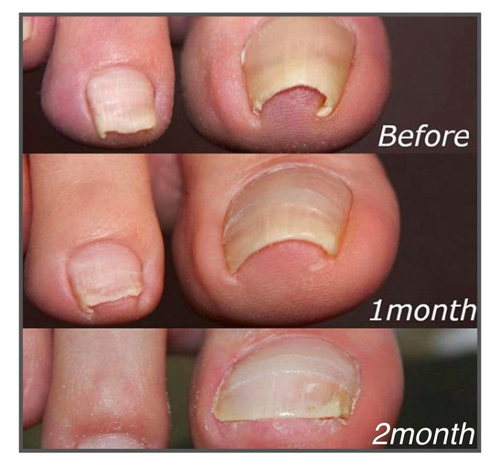 Praktische Nagelpflege-Pflaster zur optischen Korrektur von Zehennägeln. Perfekt für diskrete Pediküre zu Hause.