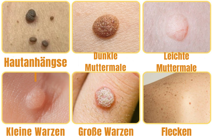 Schmerzfreies Warzenentferner Spray mit Bienengift. Fördert ein klares Hautbild und intensive Hautpflege.